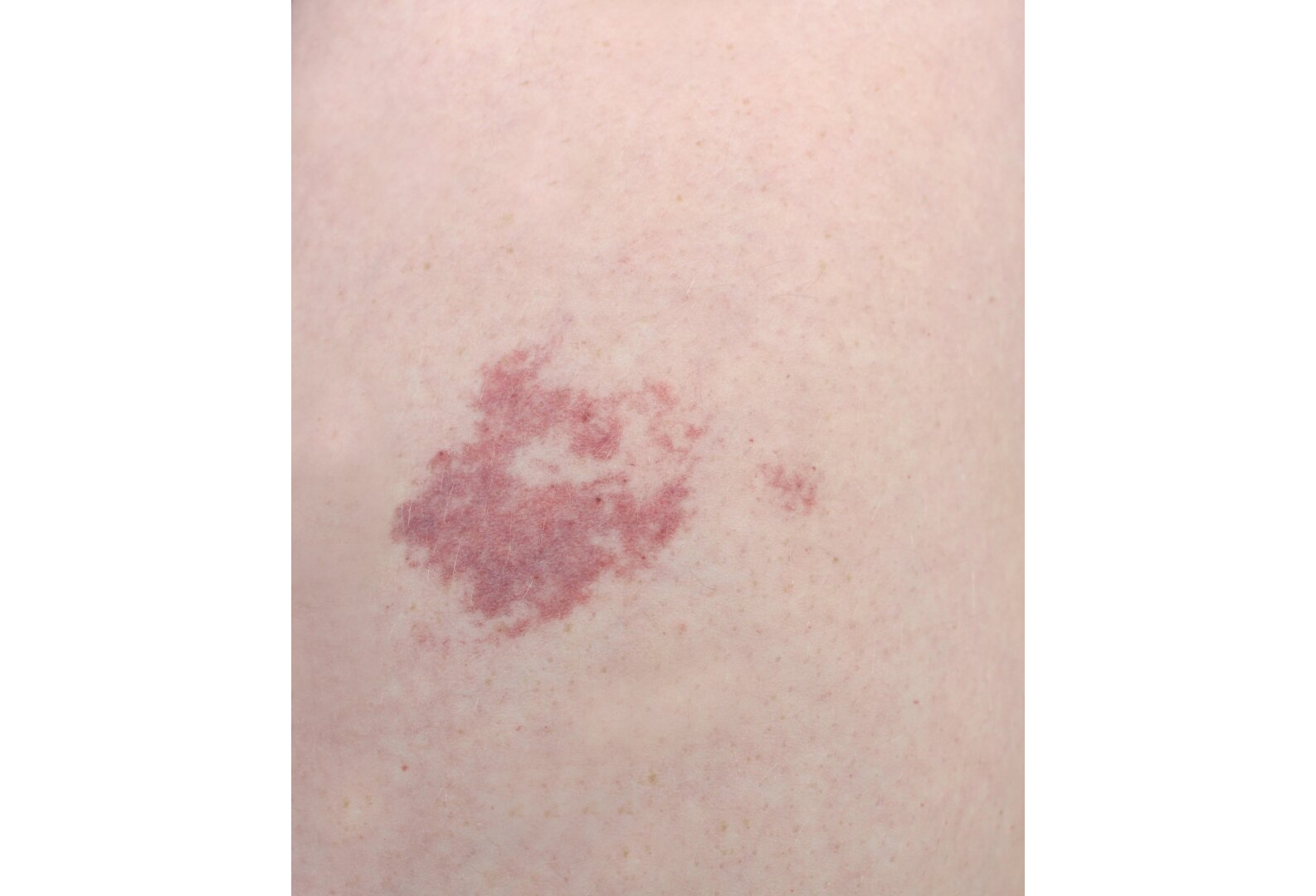 hemangioma - Visuotinė lietuvių enciklopedija
